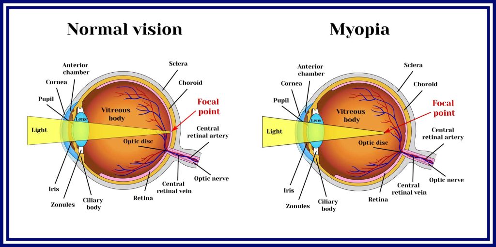 myopia with presbyopia